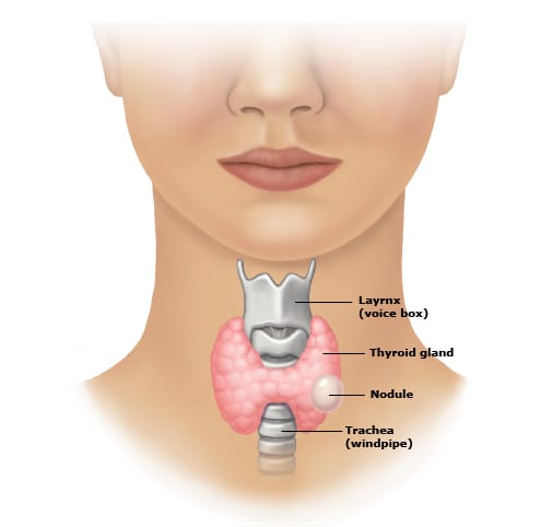 Image result for Thyroid nodule