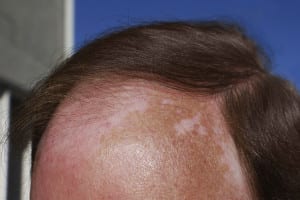 Sunburns, above, and increased sun exposure increase an individual’s risk of getting skin cancer like Melanoma, which accounts for four percent of cases, but 75 percent of skin cancer-related deaths according to Dr. Huston. Photo from Alexandra Zendrian