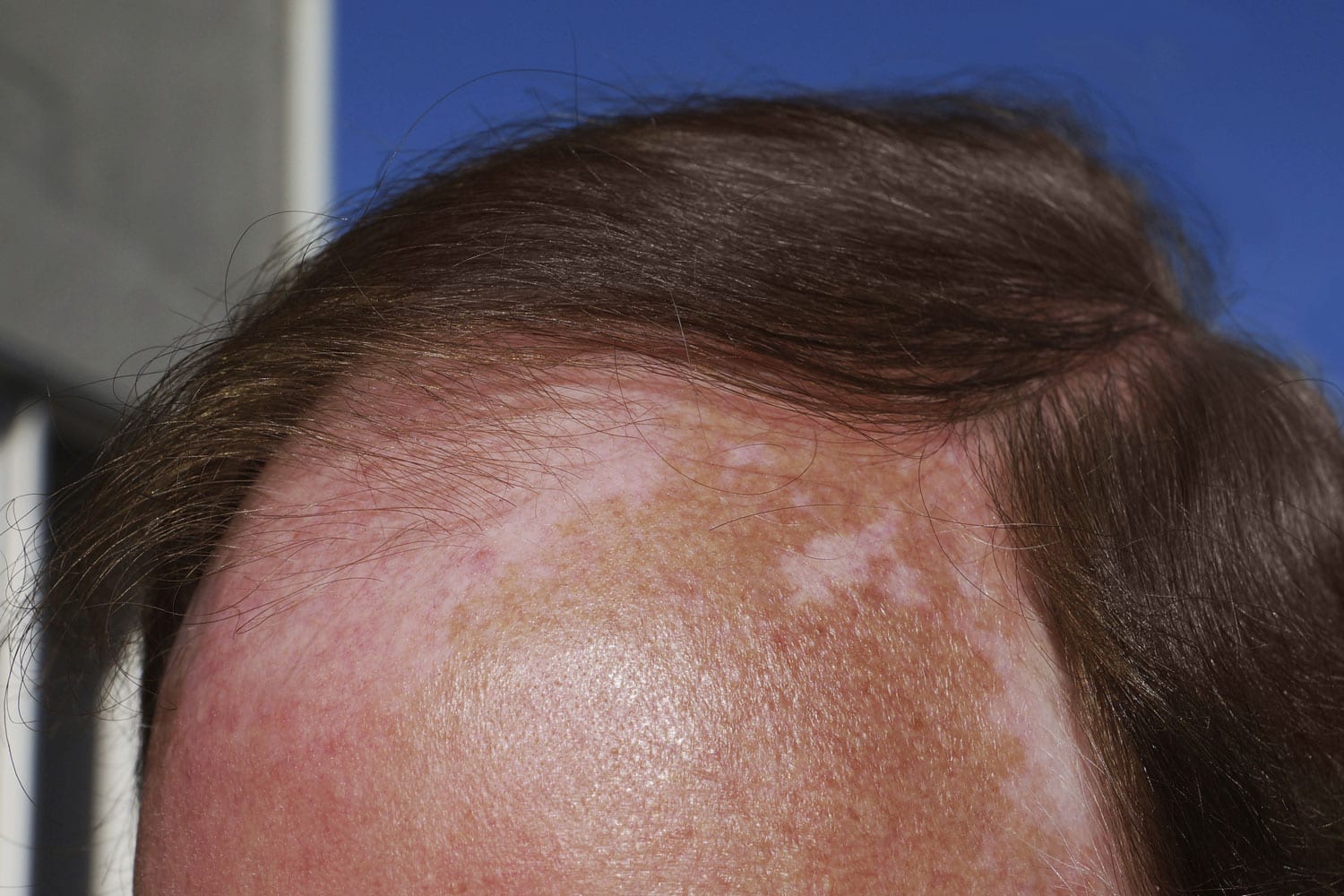 Skin Cancer On Scalp Update Berita Olahraga Dalam Luar