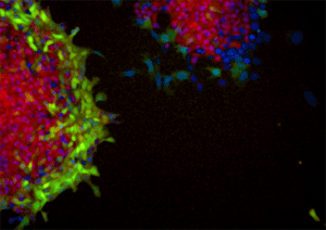 Remedy plan technology uses fluorescent markers that change colors when certain parts of the DNA are “turned on” in a cell. Red marks the area in the cell where embryonic properties are present. This indicates how metastatic a cell is. When testing for potential drug candidates, a change from red to green or blue means the drug is reducing or “turning off” the metastatic properties. Courtesy Remedy Plan. 