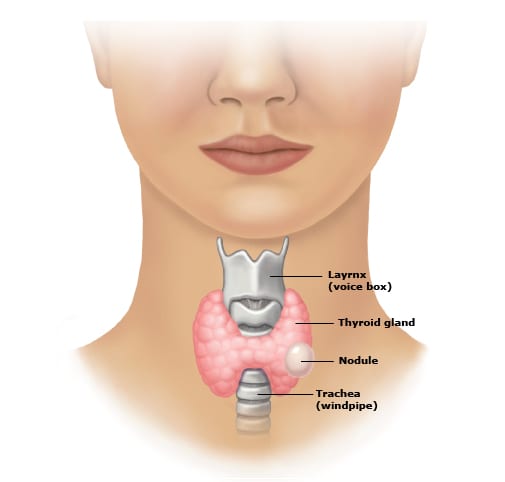 What Is A Complex Nodule On The Thyroid